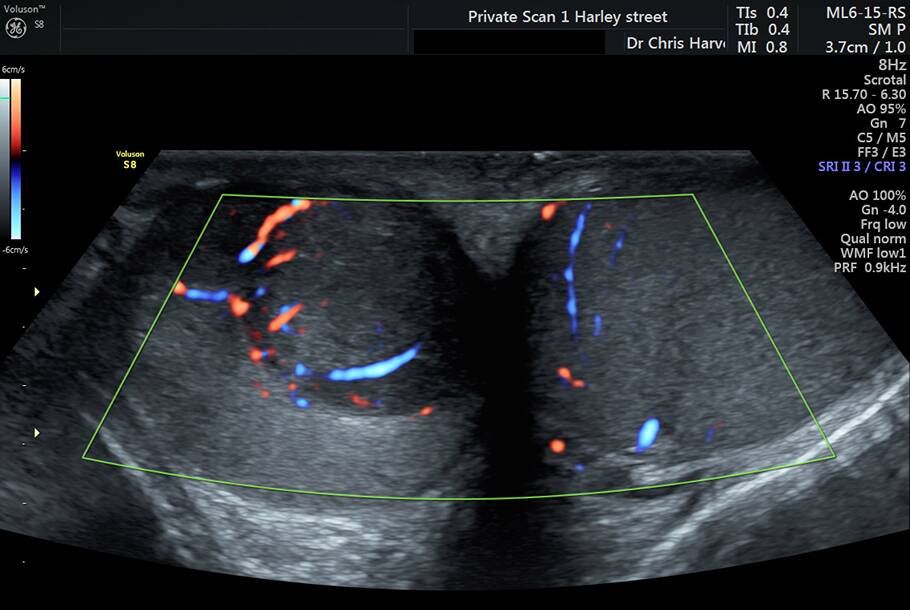 Testicular Scan Private Ultrasound Scans London