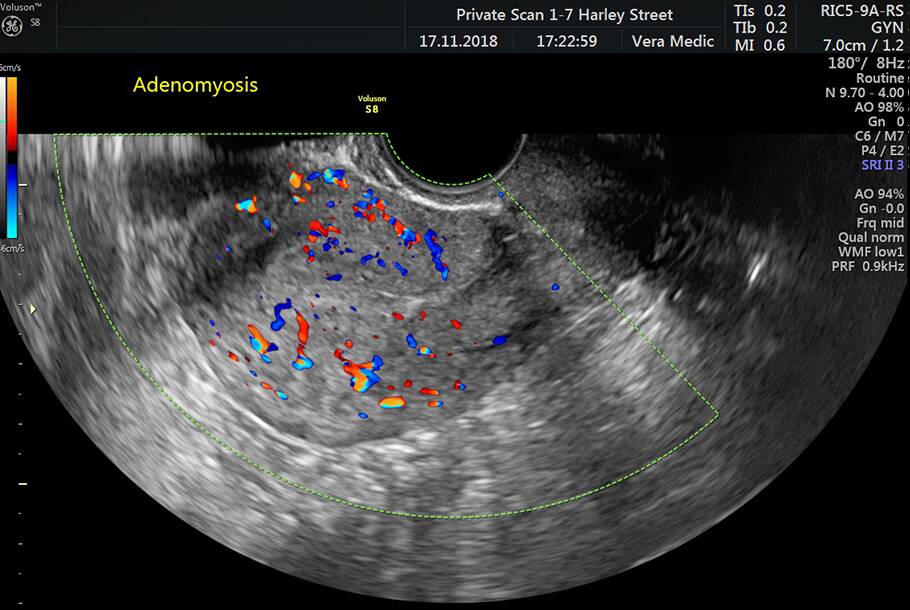 Pelvic Scan | Private Ultrasound Scans London