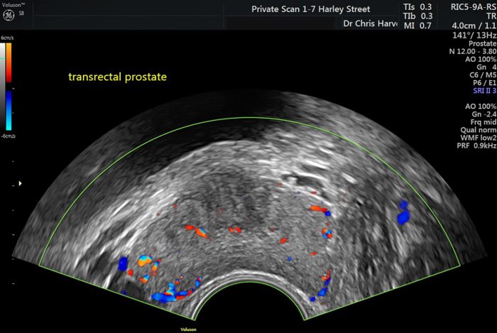 Prostate Ultrasound Scan Transrectal Private Ultrasound Scans London