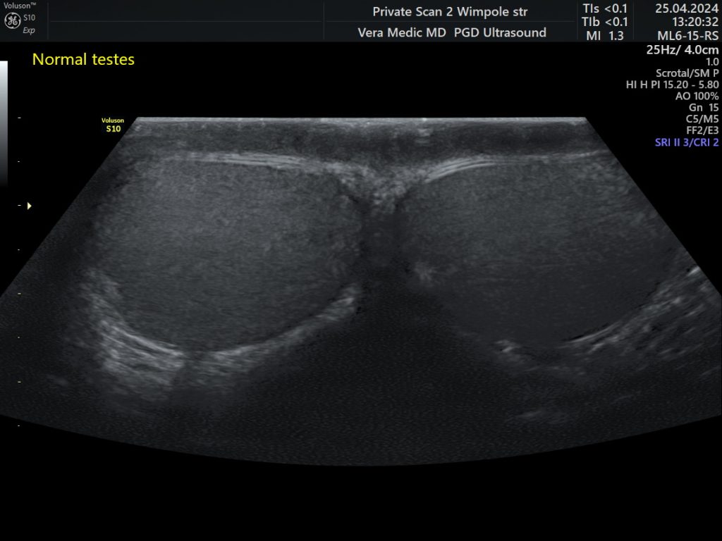 Testicular Ultrasound Scan