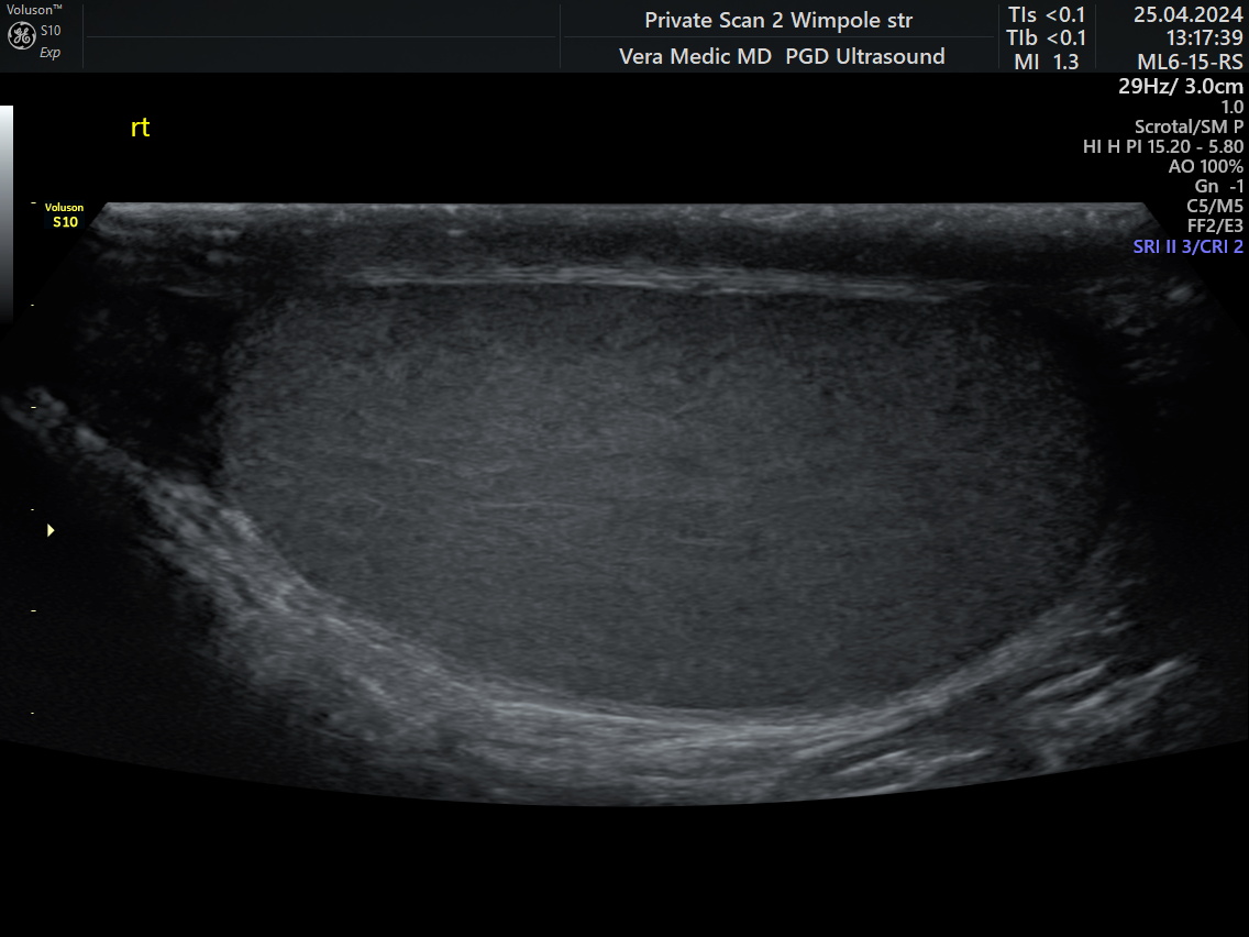 Normal Testes seen via Ultrasound